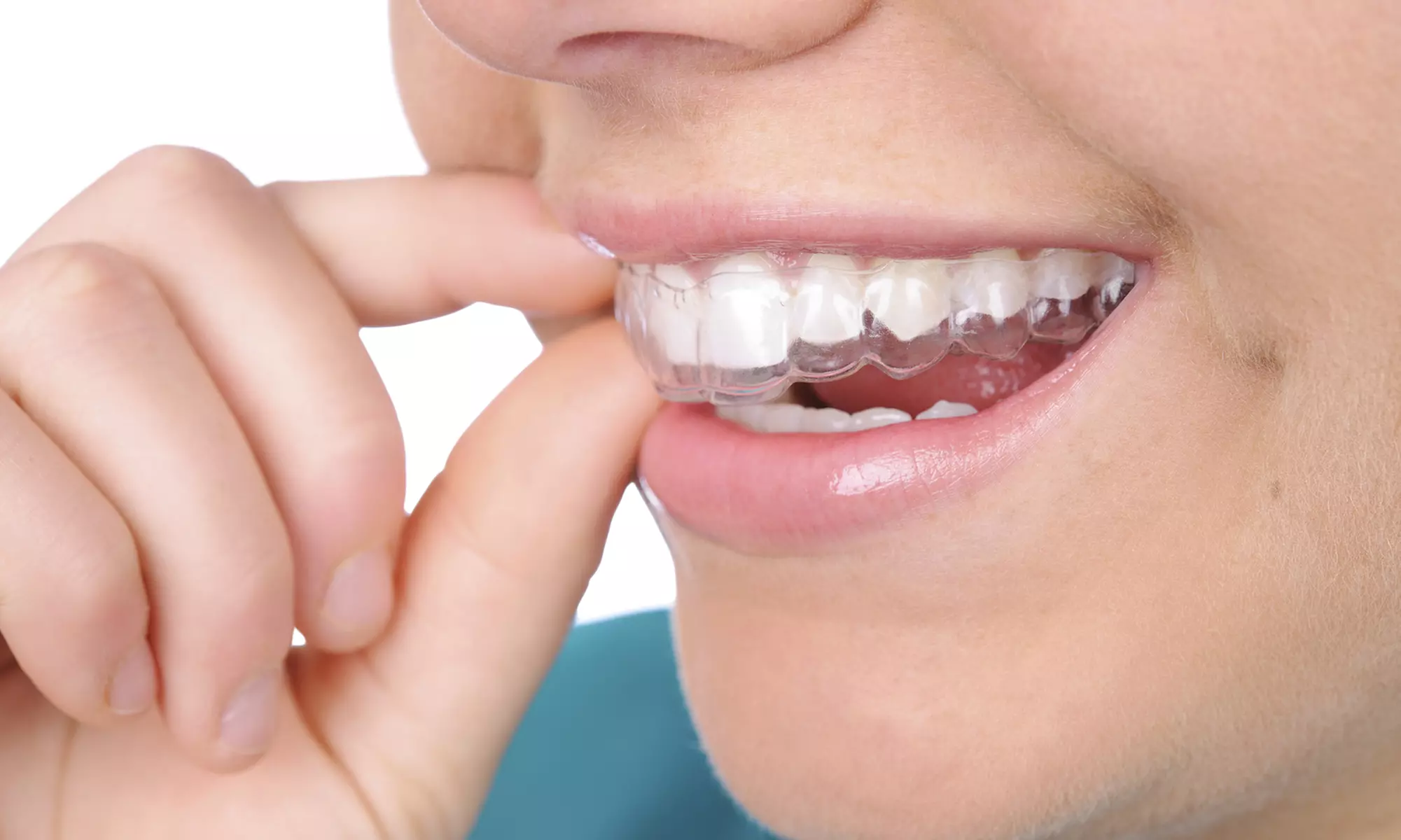 INVISIBLE BRACES IN KAMANAHALLI